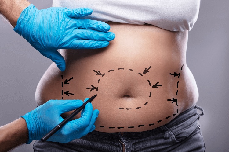 How to Prepare in Advance for Tummy Tuck Surgery