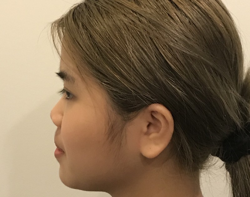 before nasal augmentation left side view female patient case 8727