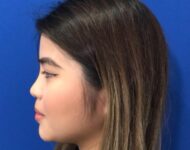 after nasal augmentation left side view female patient case 8727