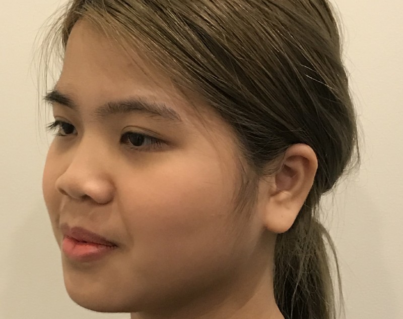 before nasal augmentation right angle view female patient case 8727
