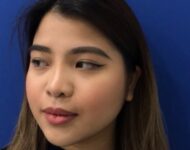 after nasal augmentation right angle view female patient case 8727