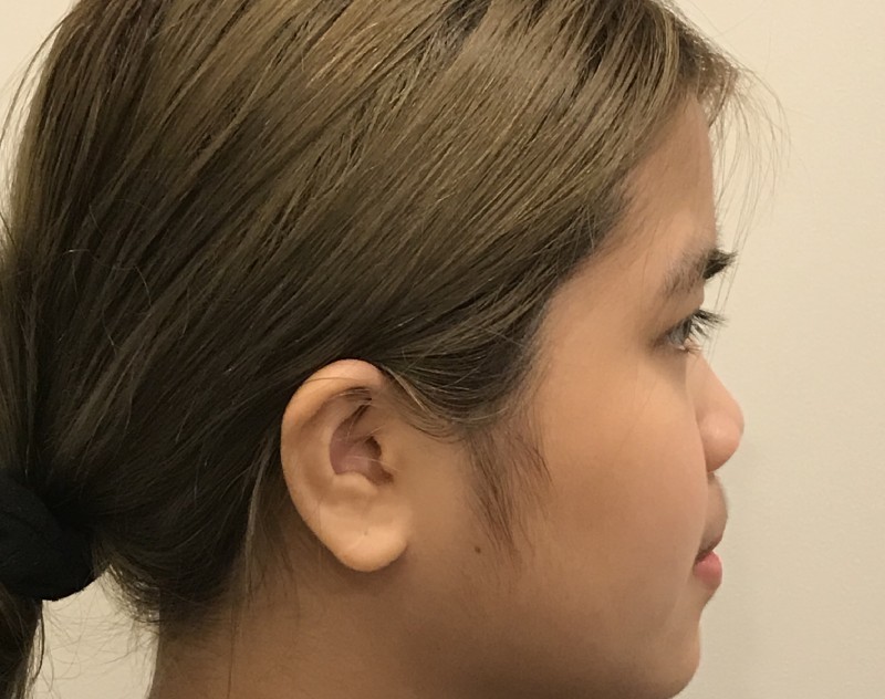 before nasal augmentation right side view female patient case 8727