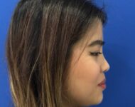 after nasal augmentation right side view female patient case 8727