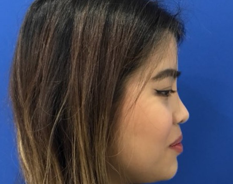 after nasal augmentation right side view female patient case 8727