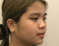 before nasal augmentation left angle view female patient case 8727