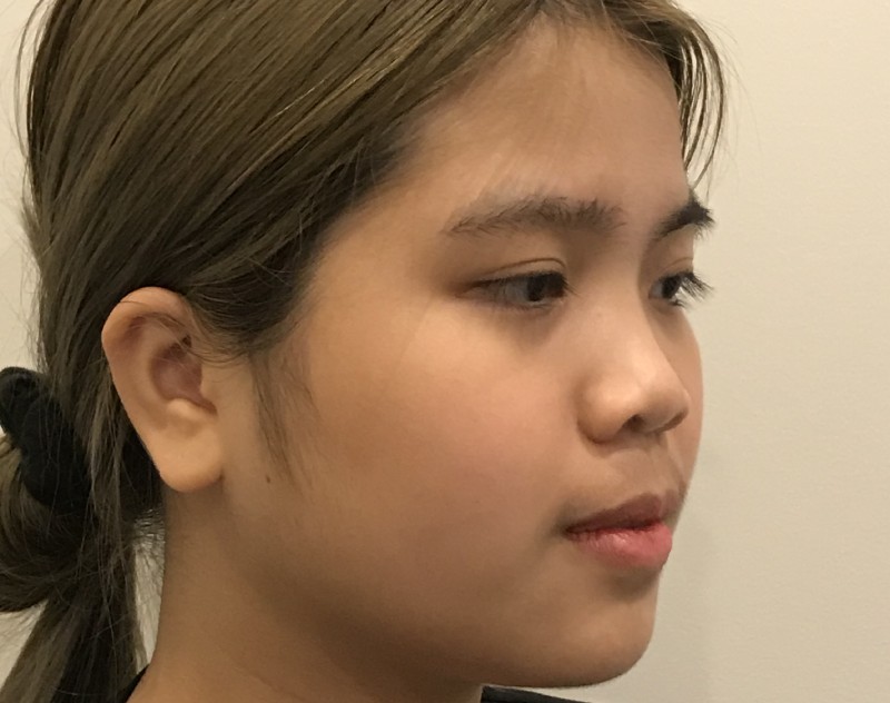 before nasal augmentation left angle view female patient case 8727