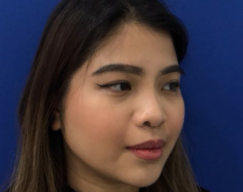 after nasal augmentation left angle view female patient case 8727