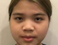 before nasal augmentation front view female patient case 8727