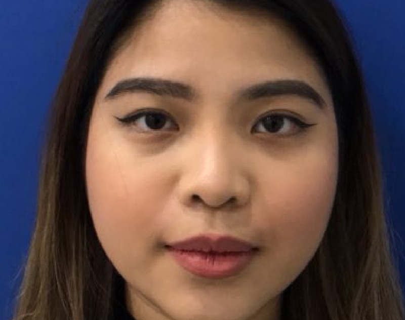 after nasal augmentation front view female patient case 8727